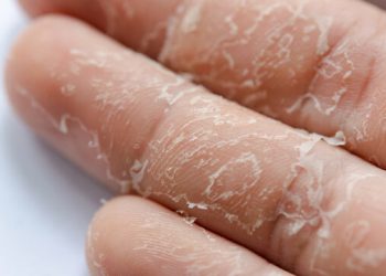 Sel Kulit Mati: Pengertian, Penyebab dan Penanganan