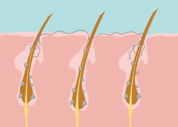 Cara Mengobati Ketombe