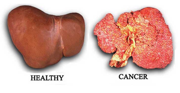 Penyebab Kanker Hati Yang Harus Diwaspadai Semua Orang