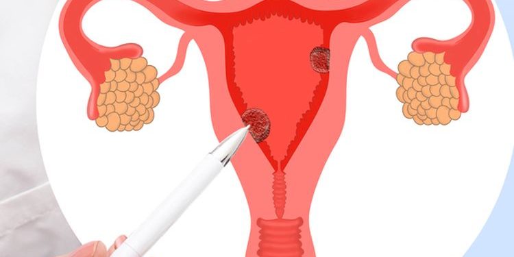 Penyebab Kanker Rahim Yang Perlu Diperhatikan Oleh Wanita