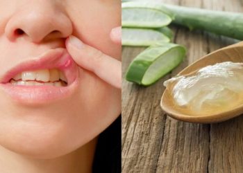 Cara Mengobati Sariawan Alami