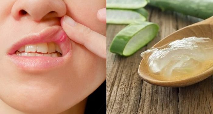 Cara Mengobati Sariawan Alami