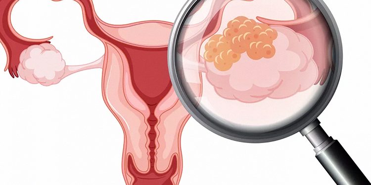 Gejala Kanker Rahim Yang Perlu Diwaspadai Wanita