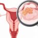 Gejala Kanker Rahim Yang Perlu Diwaspadai Wanita