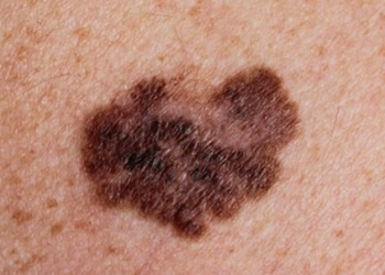 Kanker Kulit: Pengertian, Jenis, Penyebab, Gejala, Efek, dan Cara Mengobati