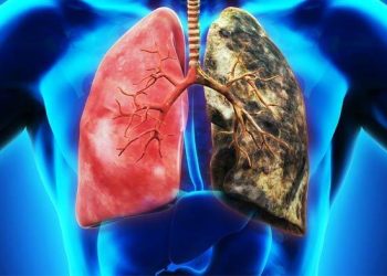 Kanker Paru-Paru; Jenis, Gejala, Penyebab, dan Cara Mengobatinya